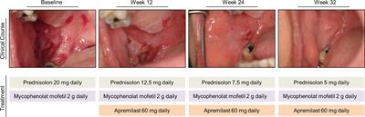 Case Report: Apremilast for Therapy-Resistant Pemphigus Vulgaris